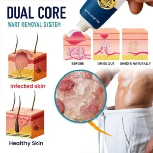 Oveallgo® Genital Warts Remover Cream