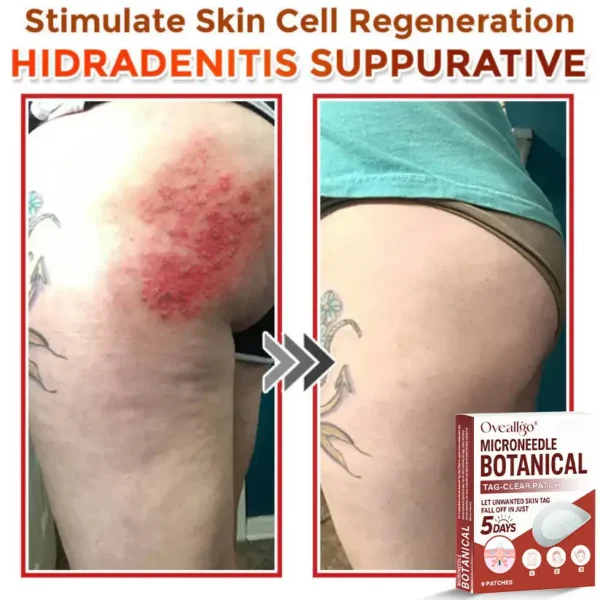 Oveallgo® Intensive MicroNeedle Botanical Tag-Clear Patch 🇺🇸 Made in the USA