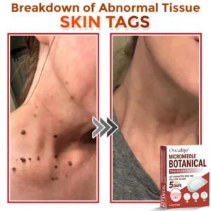 Oveallgo® Intensive MicroNeedle Botanical Tag-Clear Patch 🇺🇸 Made in the USA