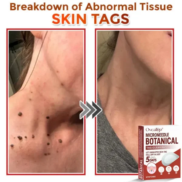 Oveallgo® Intensive MicroNeedle Botanical Tag-Clear Patch 🇺🇸 Made in the USA