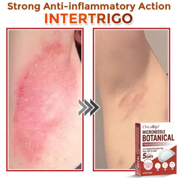 Oveallgo® Intensive MicroNeedle Botanical Tag-Clear Patch 🇺🇸 Made in the USA