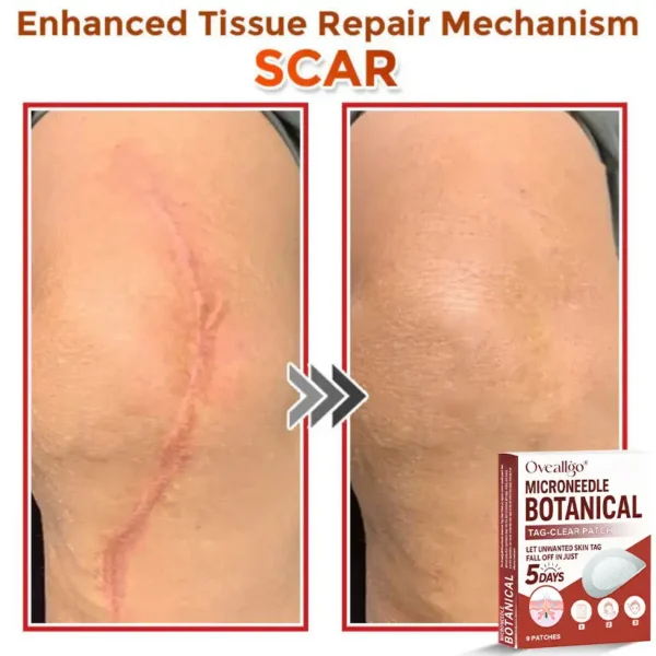 Oveallgo® MicroNeedle Botanical Tag-Clear Patch 🇺🇸 Made in the USA