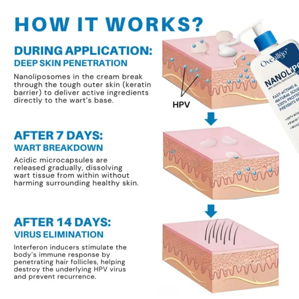 Oveallgo® NanoLipo Advanced HPV Genital Warts Eraser Cream