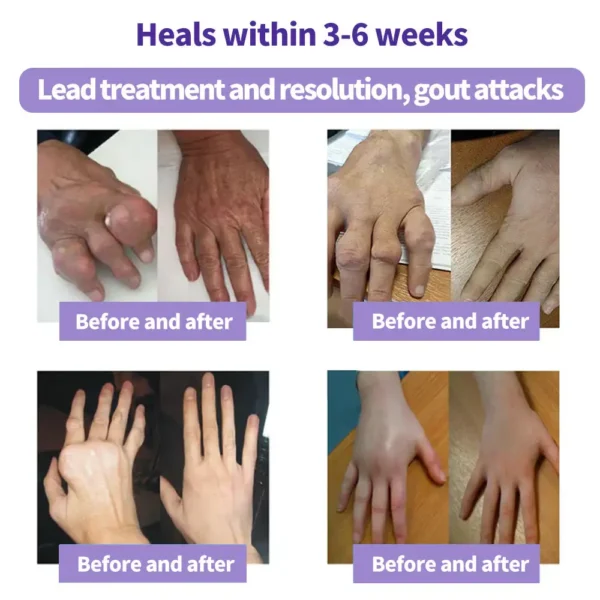 Oveallgo® Turmeric & Emu Oil Arthritis Soothing Pain Relief Massage Gel 👨‍⚕️Australian Osteopathic Association （AOA）Approved