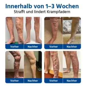 Oveallgo® 𝐕𝐞𝐢𝐧𝐓𝐚𝐫𝐠𝐞𝐭 𝐌𝐢𝐜𝐫𝐨𝐧𝐞𝐞𝐝𝐥𝐞 𝐏𝐚𝐭𝐜𝐡